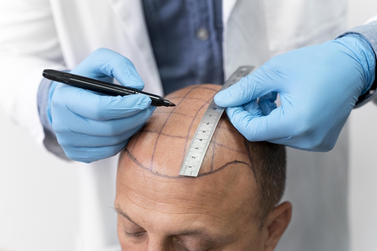Hair Transplant Marketing Agency Near Me